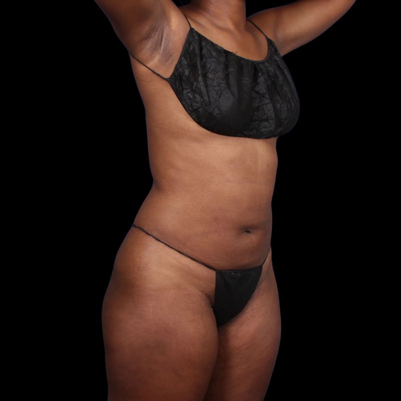 Liposuction Before & After Gallery - Patient 393787 - Image 6