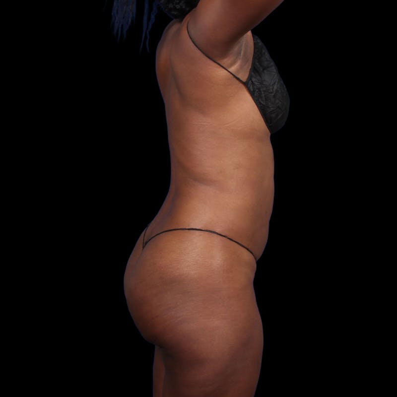 Liposuction Before & After Gallery - Patient 393787 - Image 8