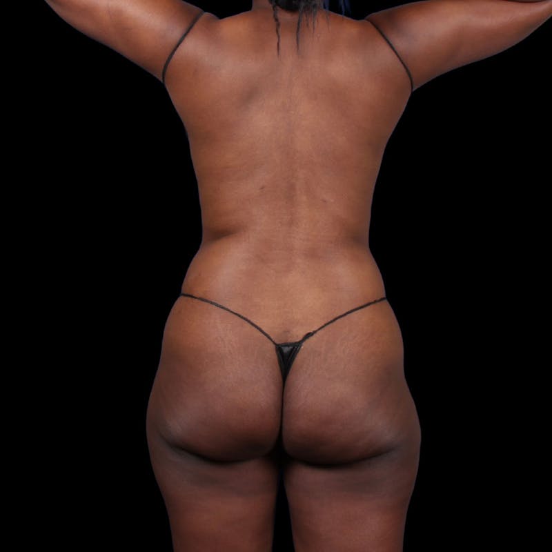 Liposuction Before & After Gallery - Patient 393787 - Image 10