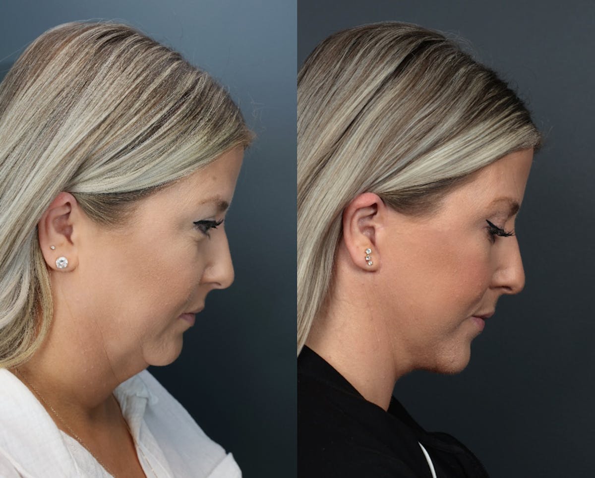 Deep Plane Facelift Before & After Gallery - Patient 250762 - Image 3