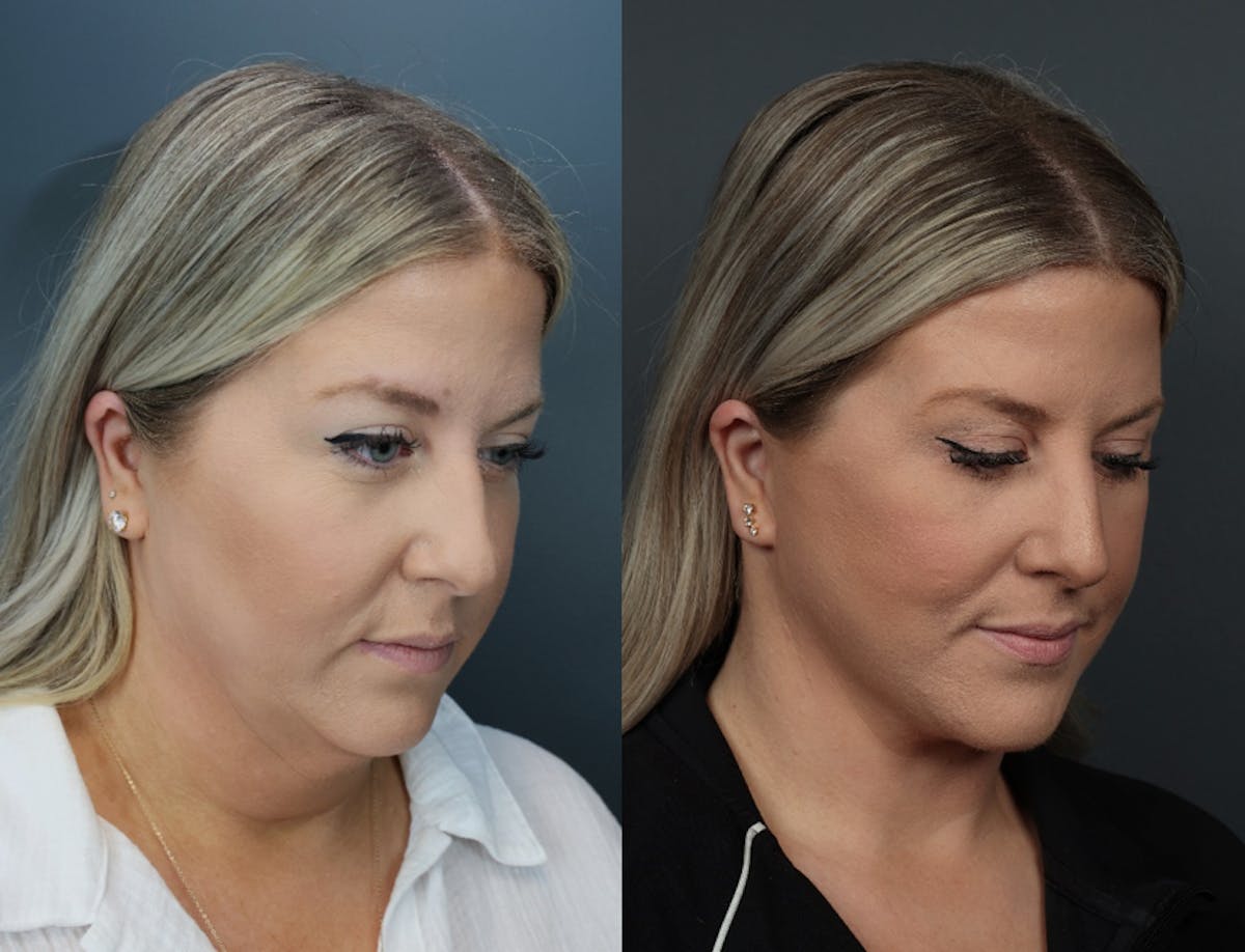 Deep Plane Facelift Before & After Gallery - Patient 250762 - Image 5