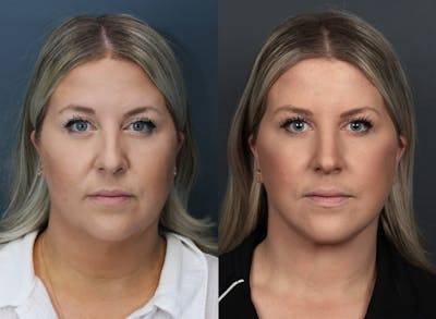 Full Facial Rejuvenation Before & After Gallery - Patient 157132 - Image 1