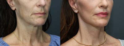 Full Facial Rejuvenation Before & After Gallery - Patient 138460 - Image 1