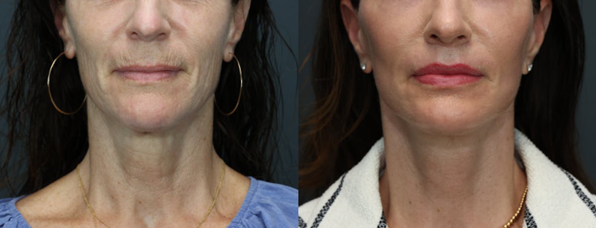 Lip Augmentation Before & After Gallery - Patient 409072 - Image 2