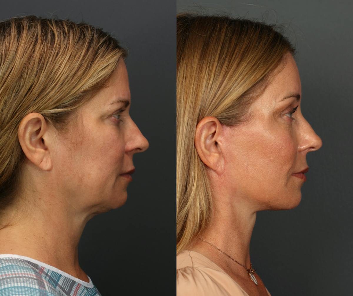 Deep Plane Neck Lift Before & After Gallery - Patient 340248 - Image 3
