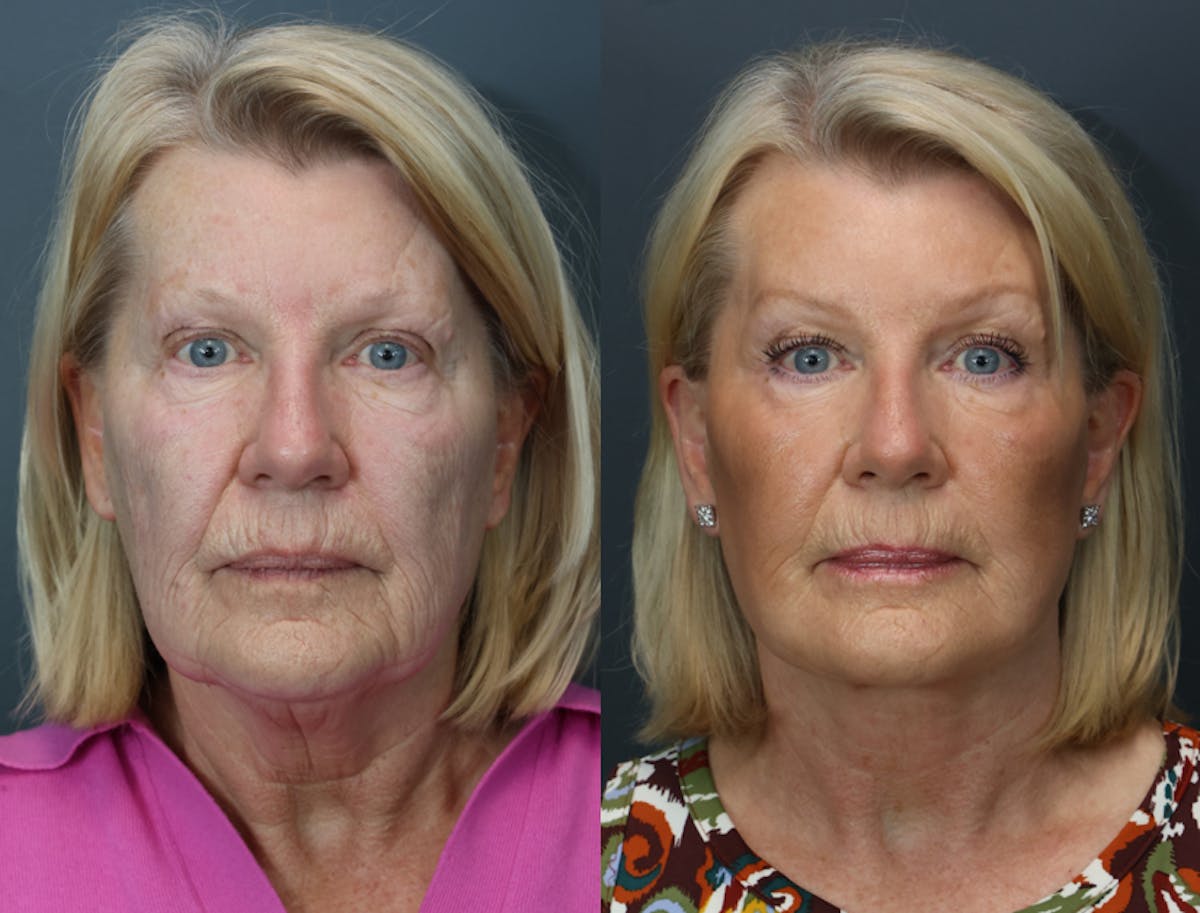 Full Facial Rejuvenation Before & After Gallery - Patient 177995 - Image 1