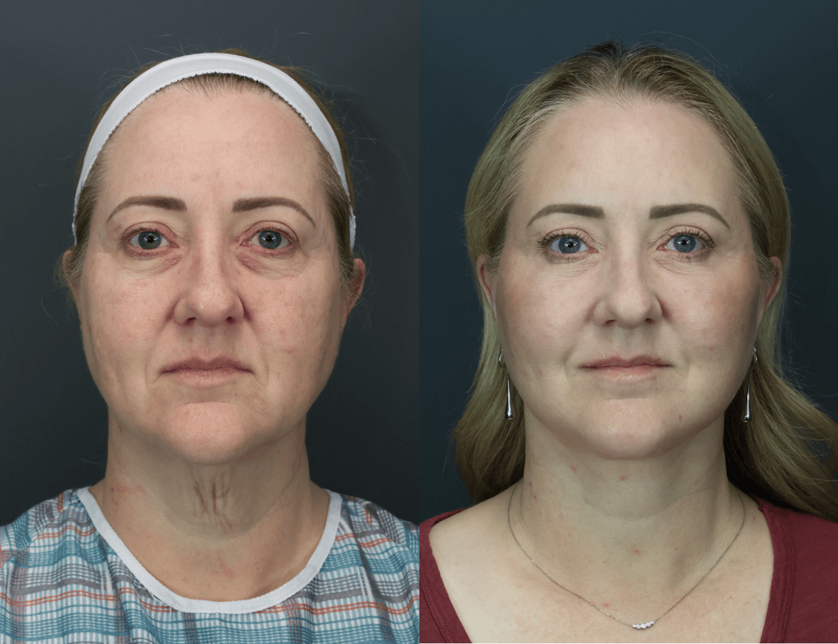 Eyelid Surgery Before & After Gallery - Patient 221746 - Image 1