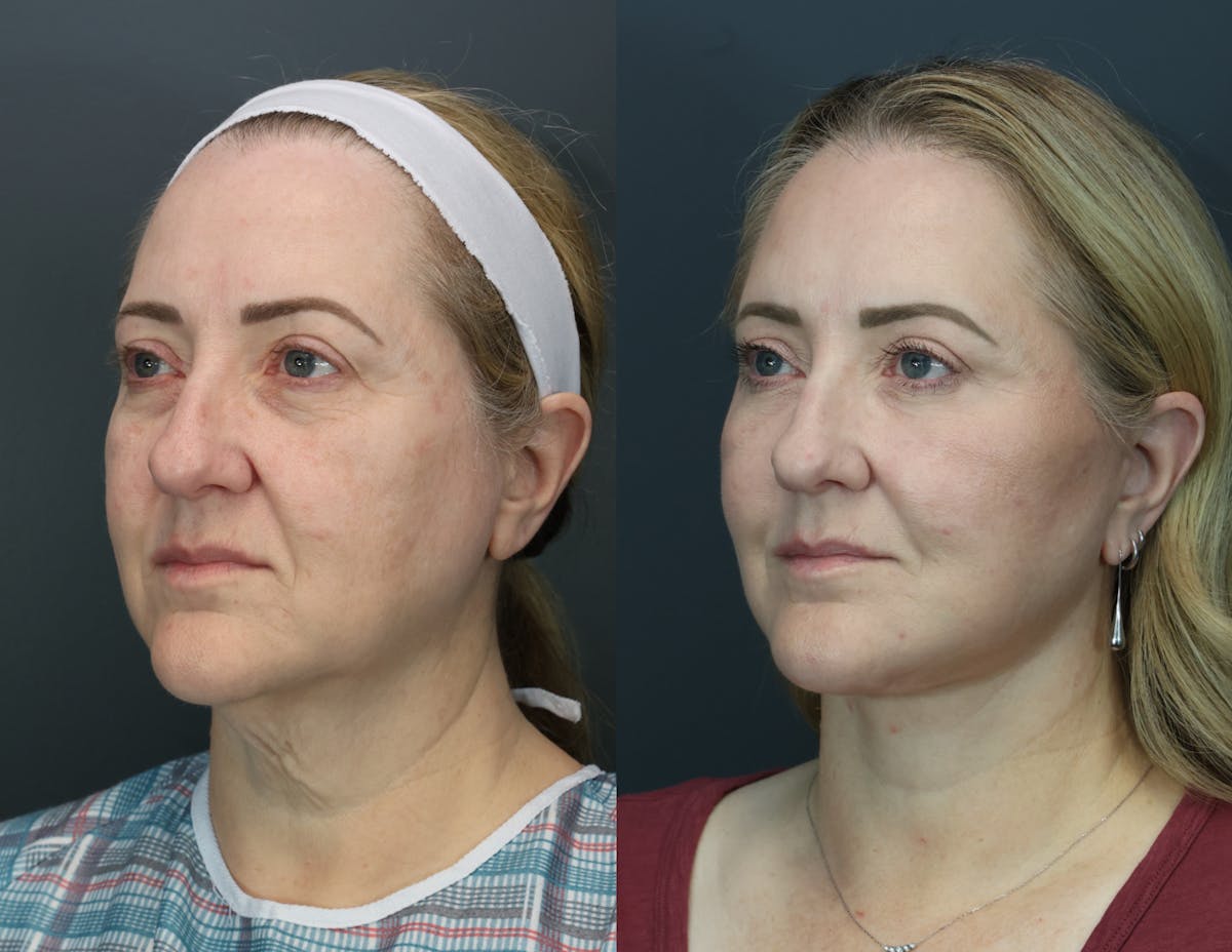 Eyelid Surgery Before & After Gallery - Patient 221746 - Image 2