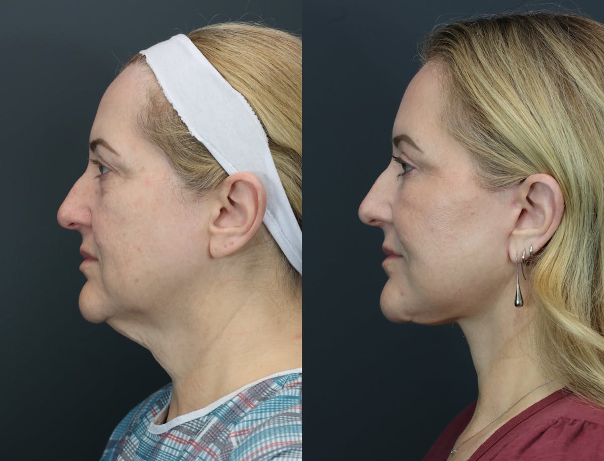 Eyelid Surgery Before & After Gallery - Patient 221746 - Image 3
