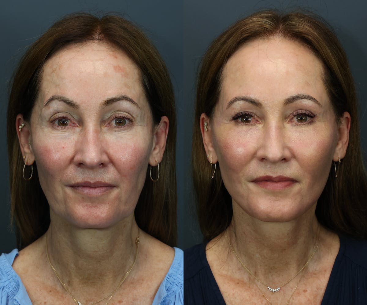 Deep Plane Facelift Before & After Gallery - Patient 877385 - Image 1