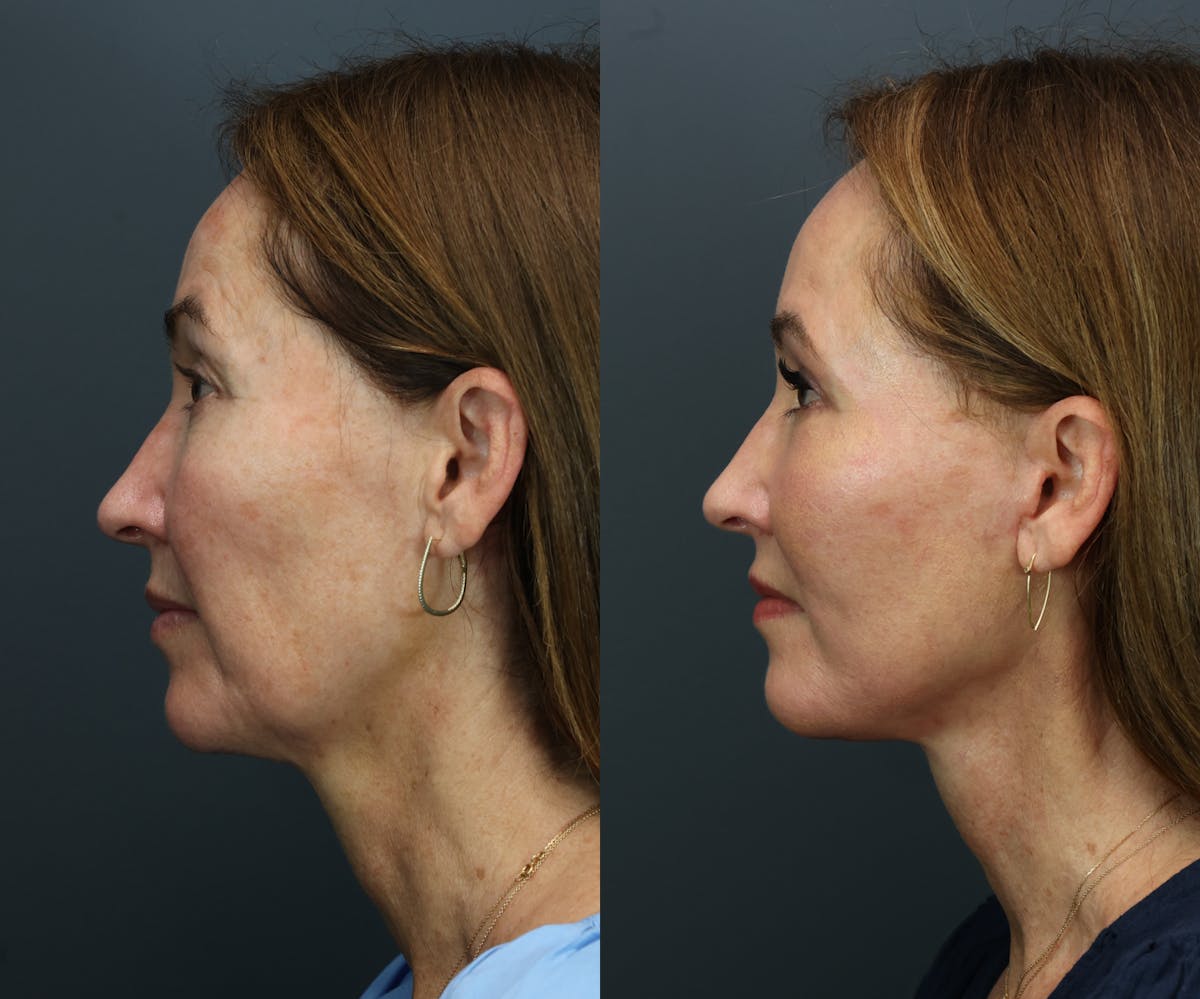 Deep Plane Facelift Before & After Gallery - Patient 877385 - Image 2