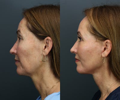 Full Facial Rejuvenation Before & After Gallery - Patient 121212 - Image 2