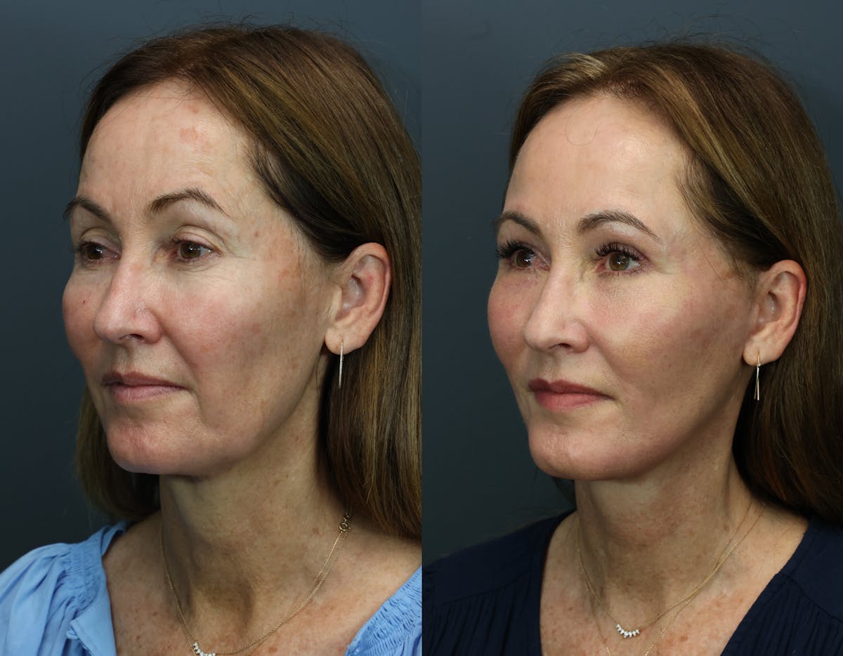 Deep Plane Facelift Before & After Gallery - Patient 877385 - Image 3