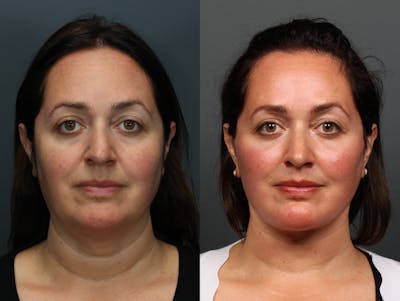 Full Facial Rejuvenation Before & After Gallery - Patient 242768 - Image 1