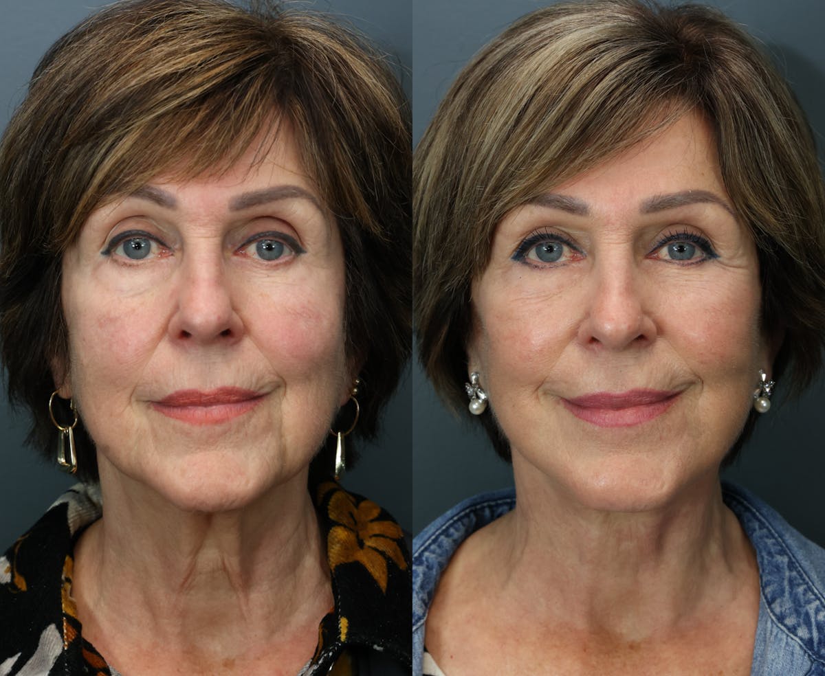 Deep Plane Facelift Before & After Gallery - Patient 147650 - Image 1