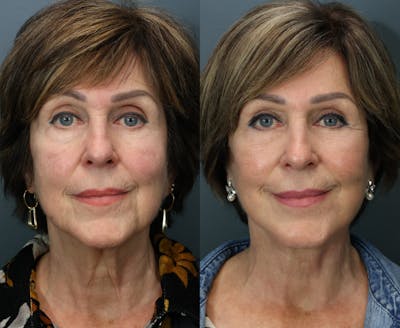 Full Facial Rejuvenation Before & After Gallery - Patient 129773 - Image 1