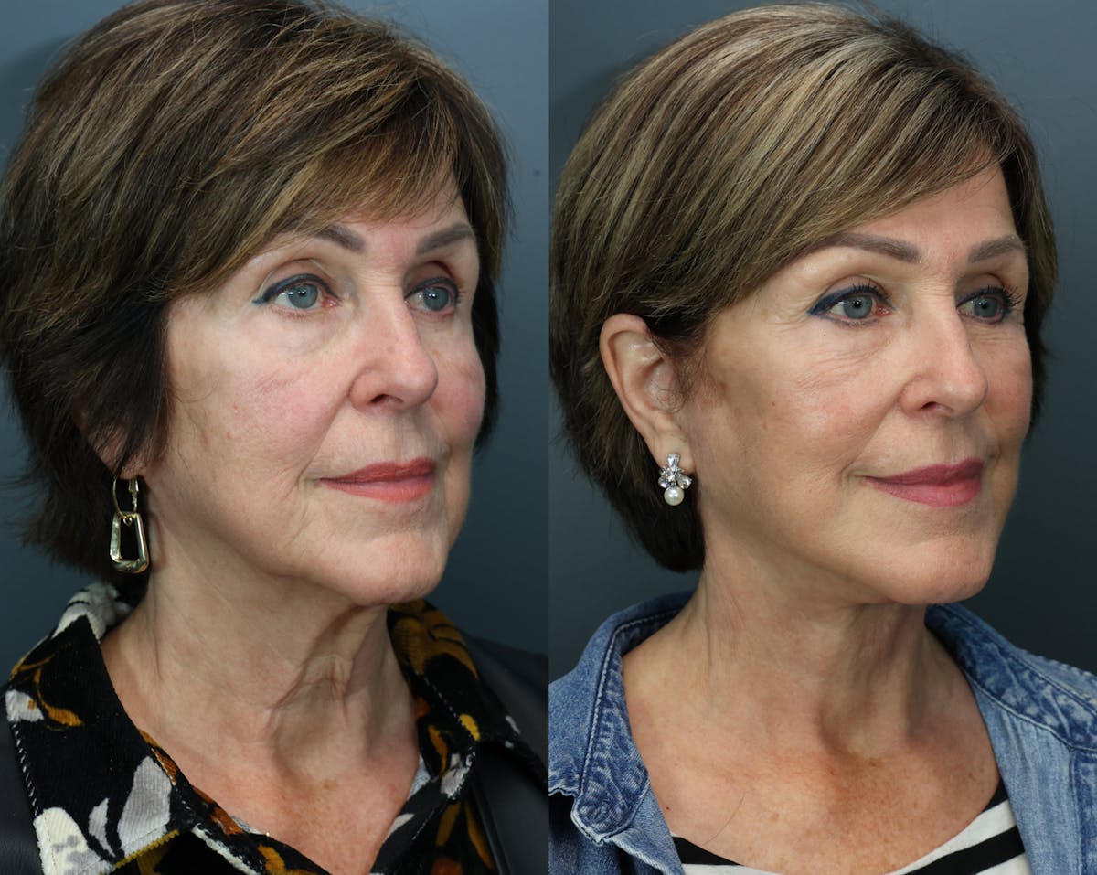 Deep Plane Facelift Before & After Gallery - Patient 147650 - Image 2