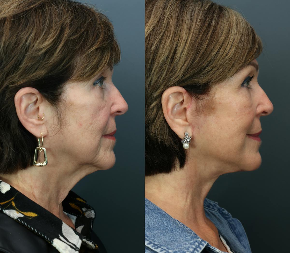 Deep Plane Facelift Before & After Gallery - Patient 147650 - Image 3