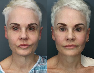 Full Facial Rejuvenation Before & After Gallery - Patient 371276 - Image 1