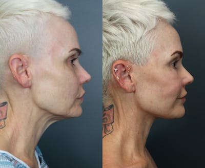 Full Facial Rejuvenation Before & After Gallery - Patient 371276 - Image 2