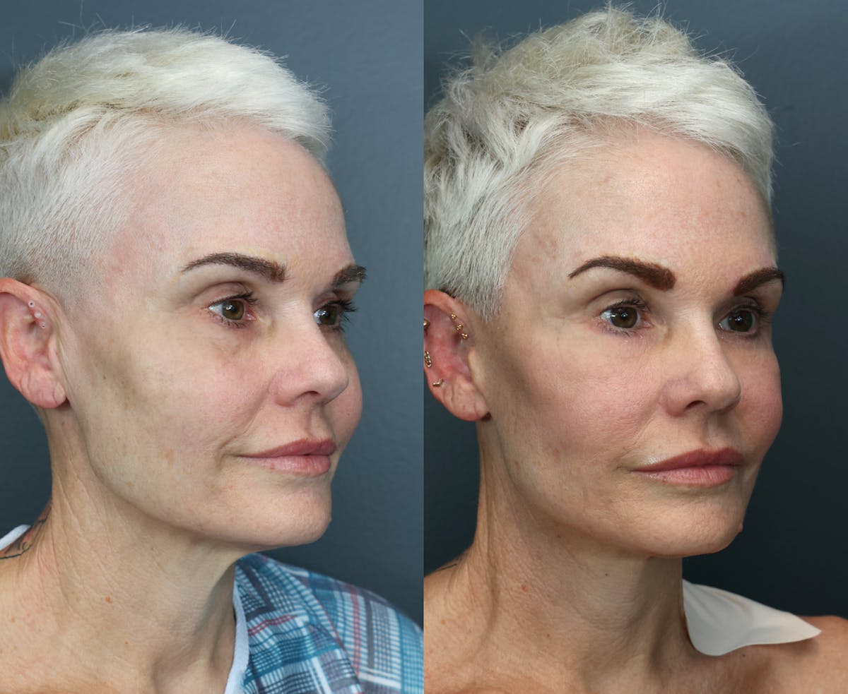 Deep Plane Facelift Before & After Gallery - Patient 408117 - Image 3