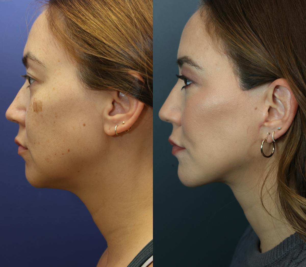 Deep Plane Facelift Before & After Gallery - Patient 308312 - Image 3