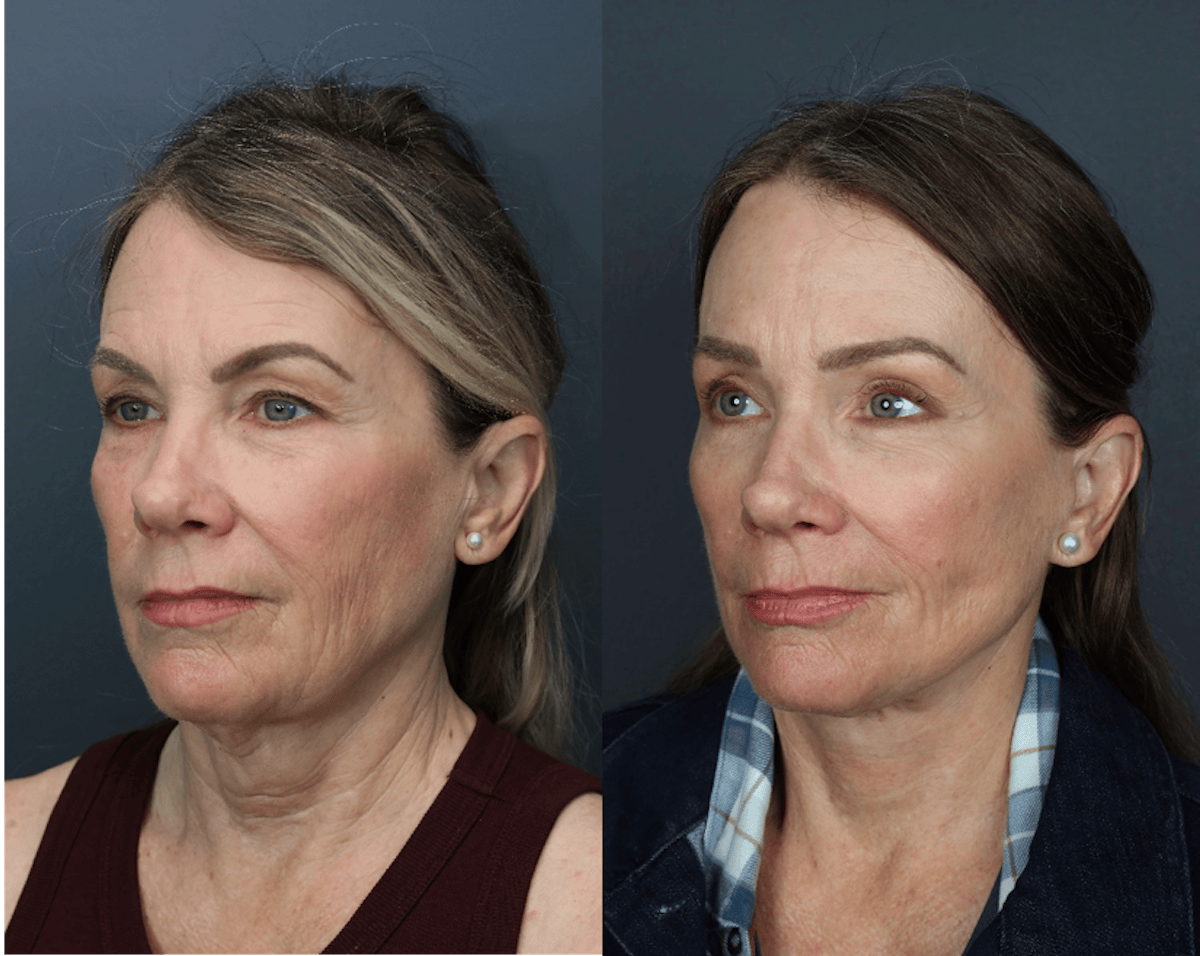 Eyelid Surgery Before & After Gallery - Patient 499336 - Image 1