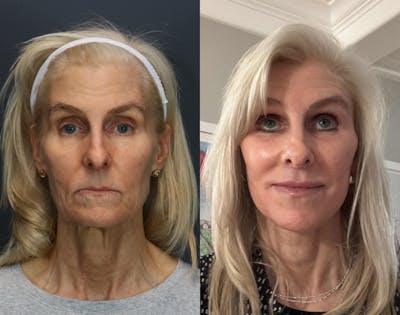 Full Facial Rejuvenation Before & After Gallery - Patient 168006 - Image 1