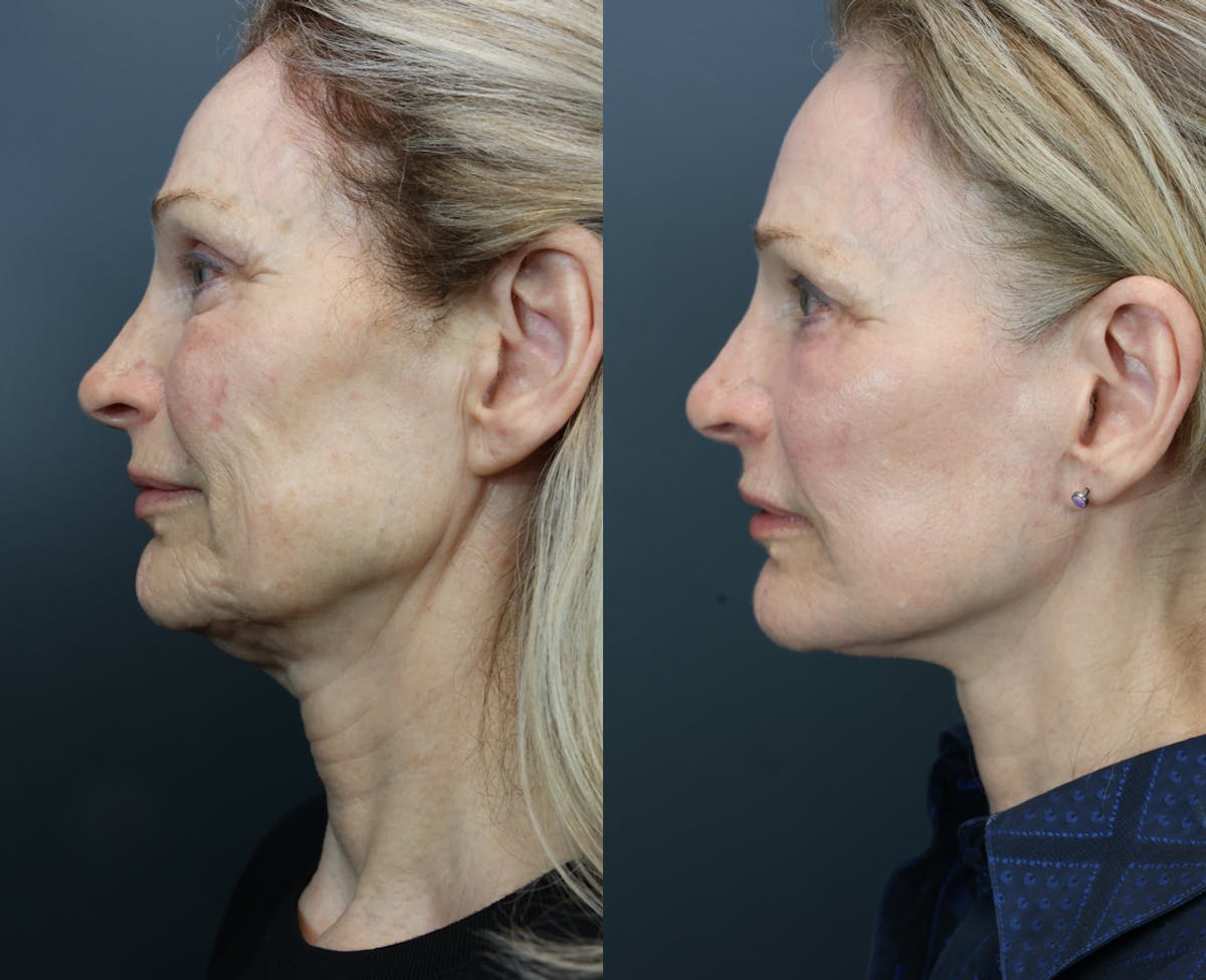 Facial Revolumizing (Fat Grafting) Before & After Gallery - Patient 160677 - Image 2
