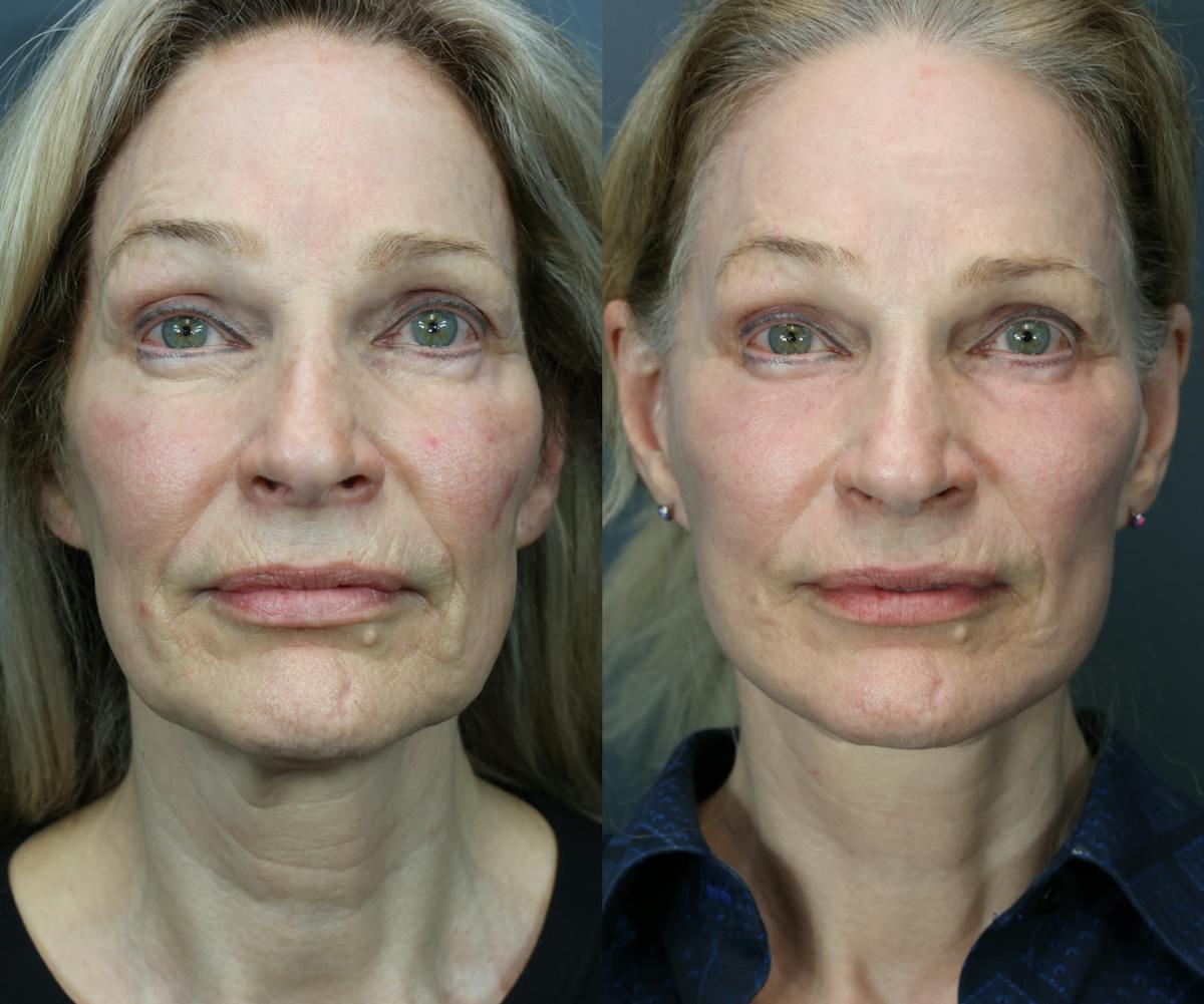 Facial Revolumizing (Fat Grafting) Before & After Gallery - Patient 160677 - Image 1