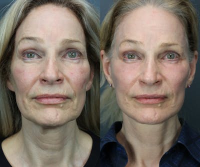 Full Facial Rejuvenation Before & After Gallery - Patient 272163 - Image 1