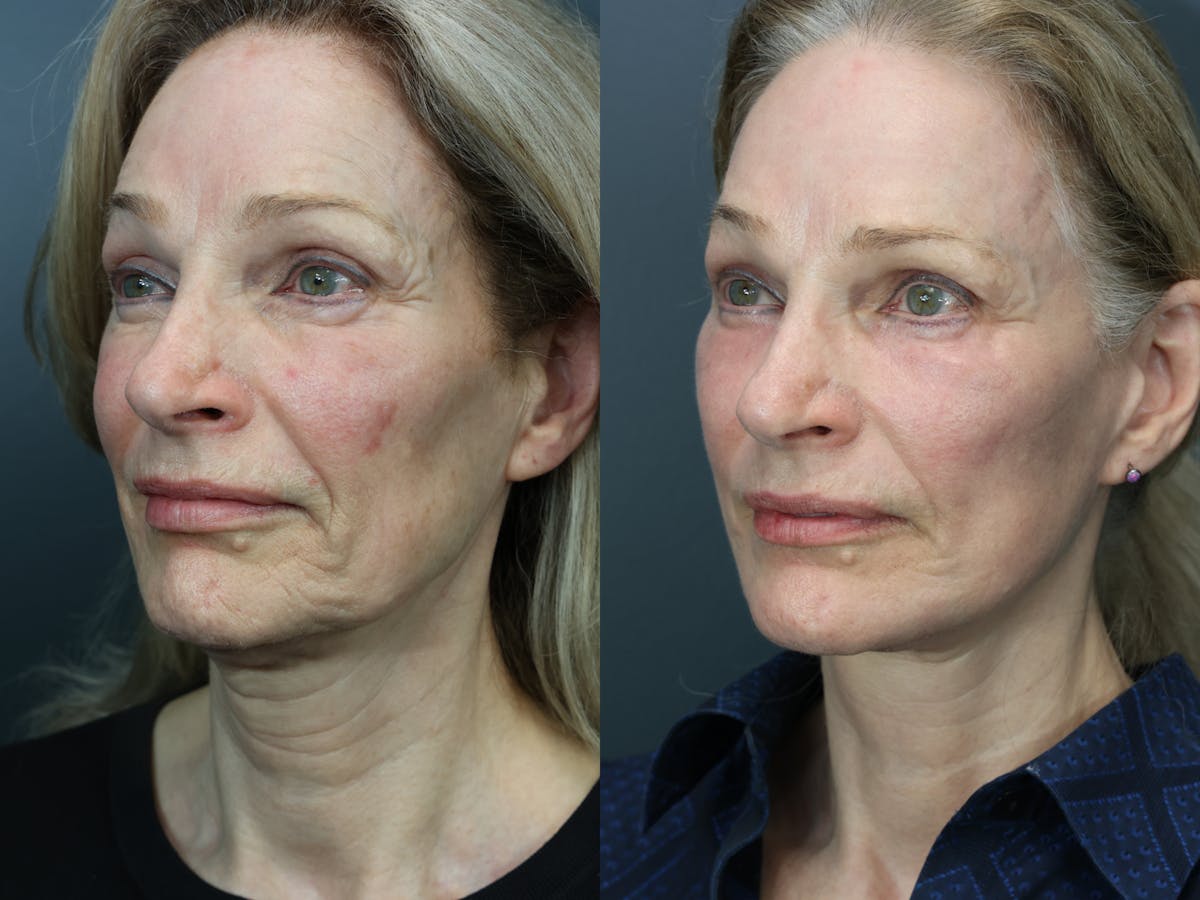 Facial Revolumizing (Fat Grafting) Before & After Gallery - Patient 160677 - Image 3