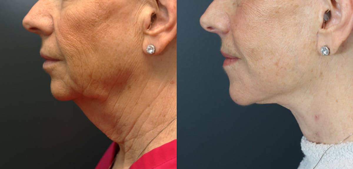 Deep Plane Facelift Before & After Gallery - Patient 260495 - Image 2