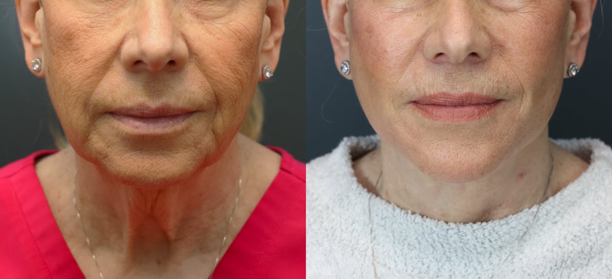 Deep Plane Facelift Before & After Gallery - Patient 260495 - Image 1