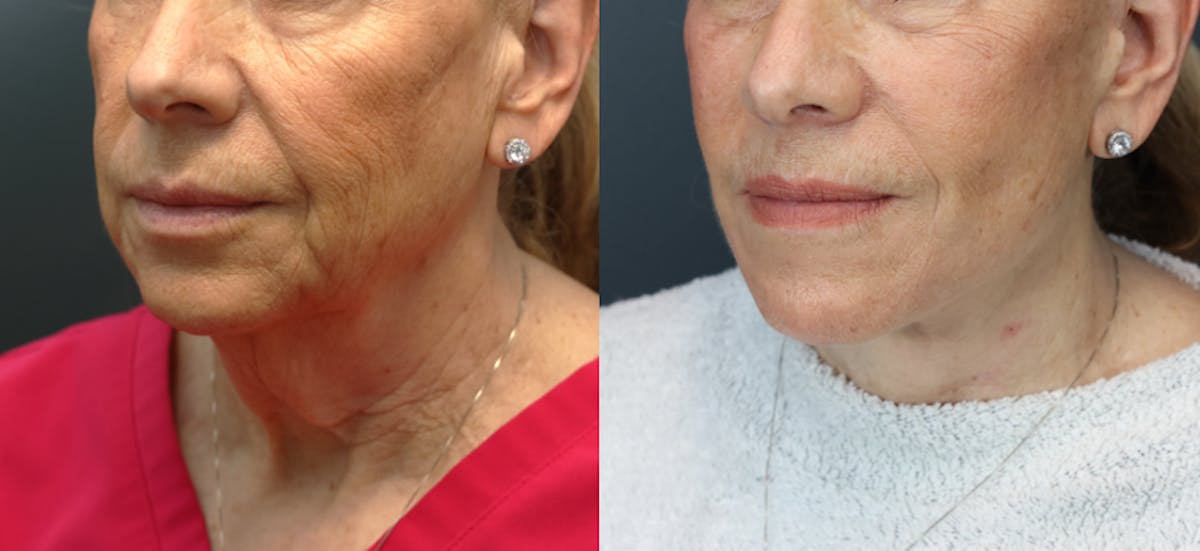 Deep Plane Facelift Before & After Gallery - Patient 260495 - Image 3
