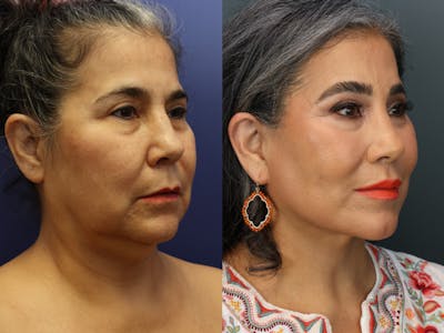 Full Facial Rejuvenation Before & After Gallery - Patient 227383 - Image 2