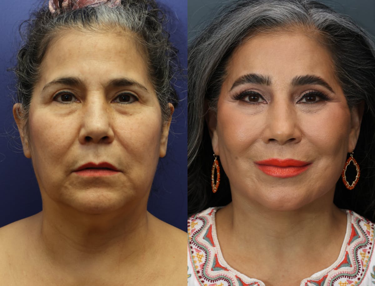 Deep Plane Neck Lift Before & After Gallery - Patient 258794 - Image 1