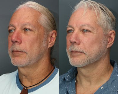 Full Facial Rejuvenation Before & After Gallery - Patient 227268 - Image 2