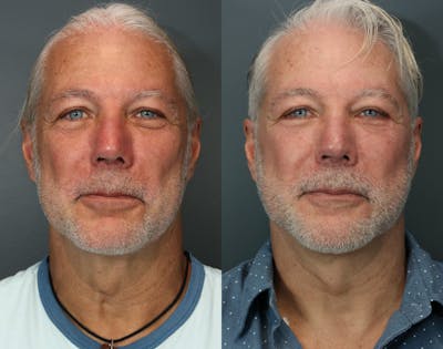 Full Facial Rejuvenation Before & After Gallery - Patient 759005 - Image 1
