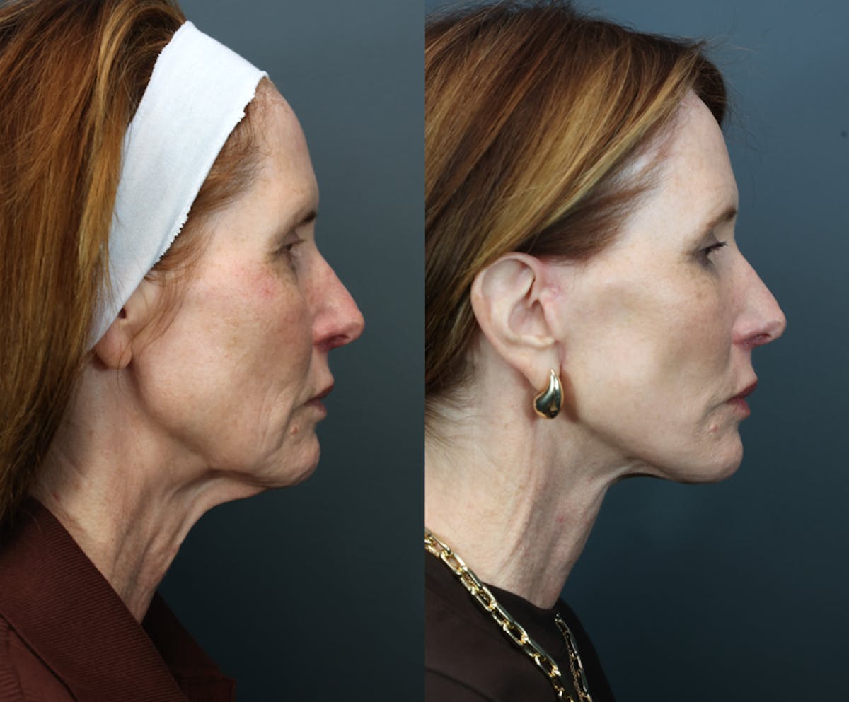 Deep Plane Facelift Before & After Gallery - Patient 168705 - Image 3