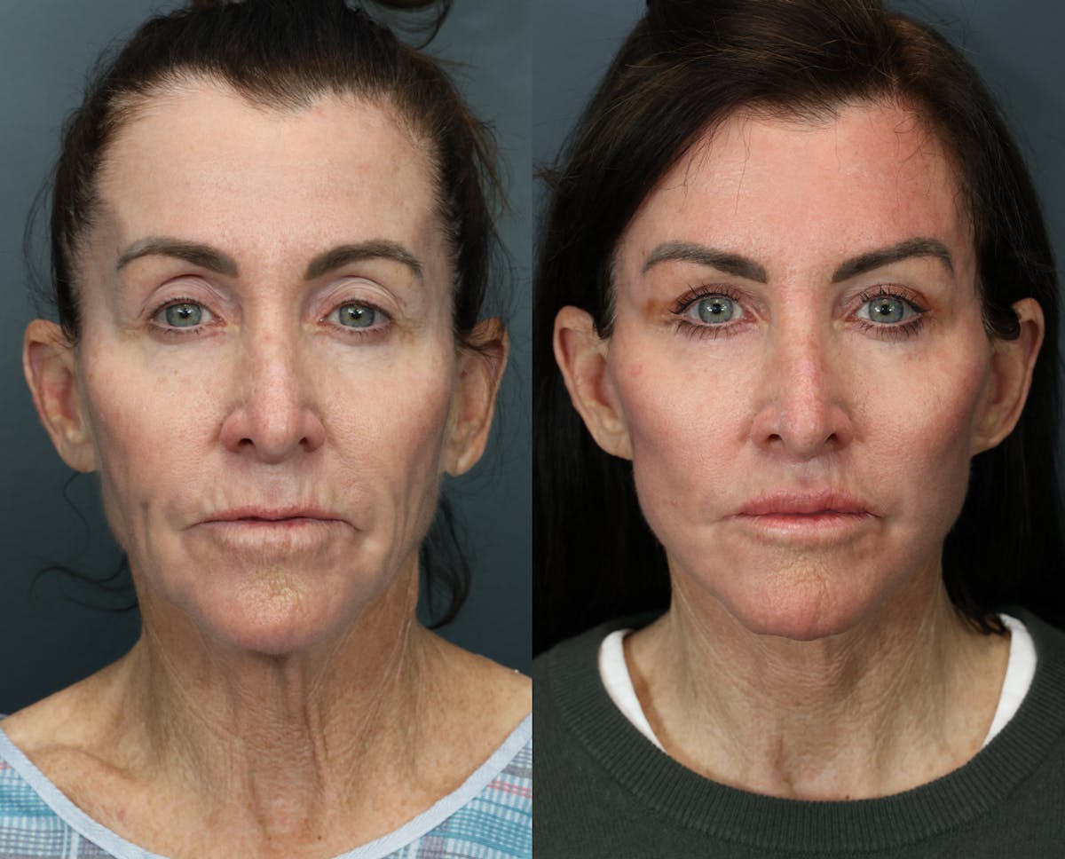 Deep Plane Facelift Before & After Gallery - Patient 390850 - Image 1