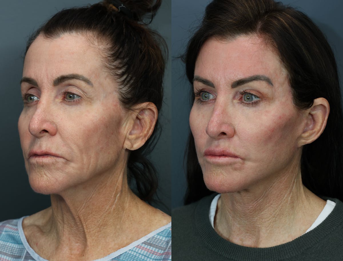 Deep Plane Facelift Before & After Gallery - Patient 390850 - Image 3