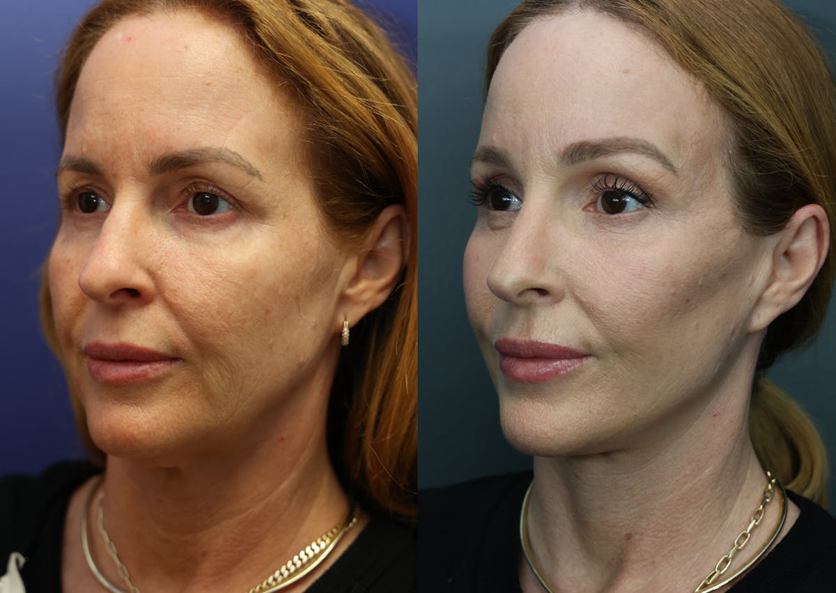 Eyelid Surgery Before & After Gallery - Patient 220048 - Image 3