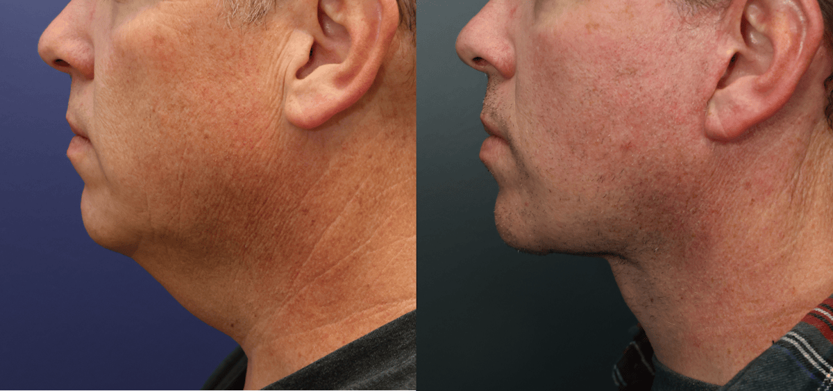 Deep Plane Neck Lift Before & After Gallery - Patient 399975 - Image 5