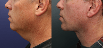 Full Facial Rejuvenation Before & After Gallery - Patient 209950 - Image 2