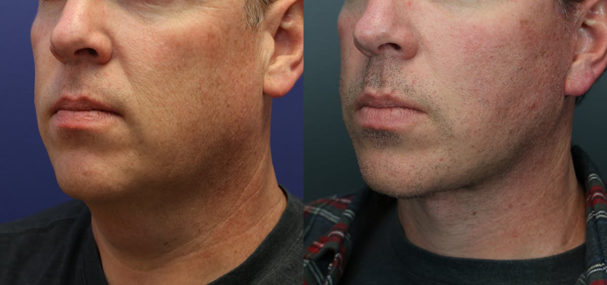Deep Plane Neck Lift Before & After Gallery - Patient 399975 - Image 4