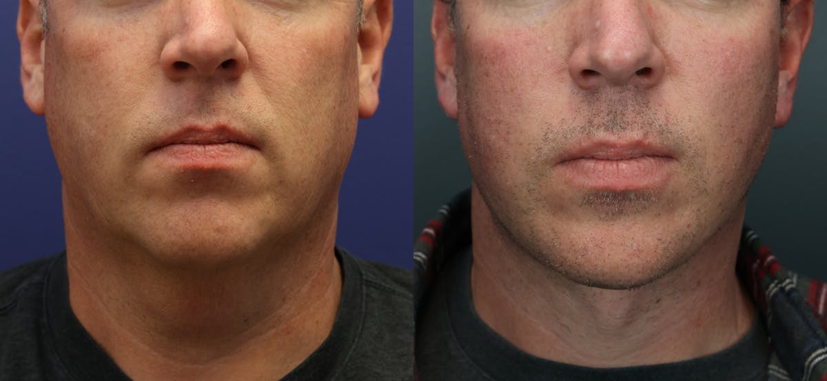 Deep Plane Neck Lift Before & After Gallery - Patient 399975 - Image 3