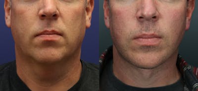 Full Facial Rejuvenation Before & After Gallery - Patient 209950 - Image 1