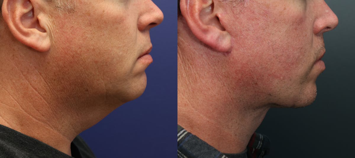 Deep Plane Neck Lift Before & After Gallery - Patient 399975 - Image 2