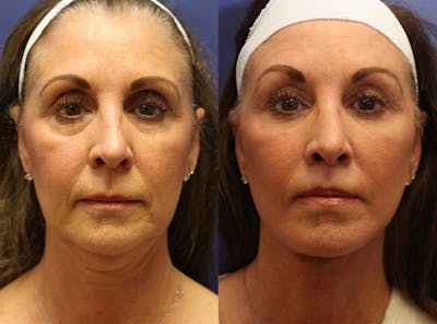 Full Facial Rejuvenation Before & After Gallery - Patient 336577 - Image 1